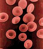 Pernicious anemia